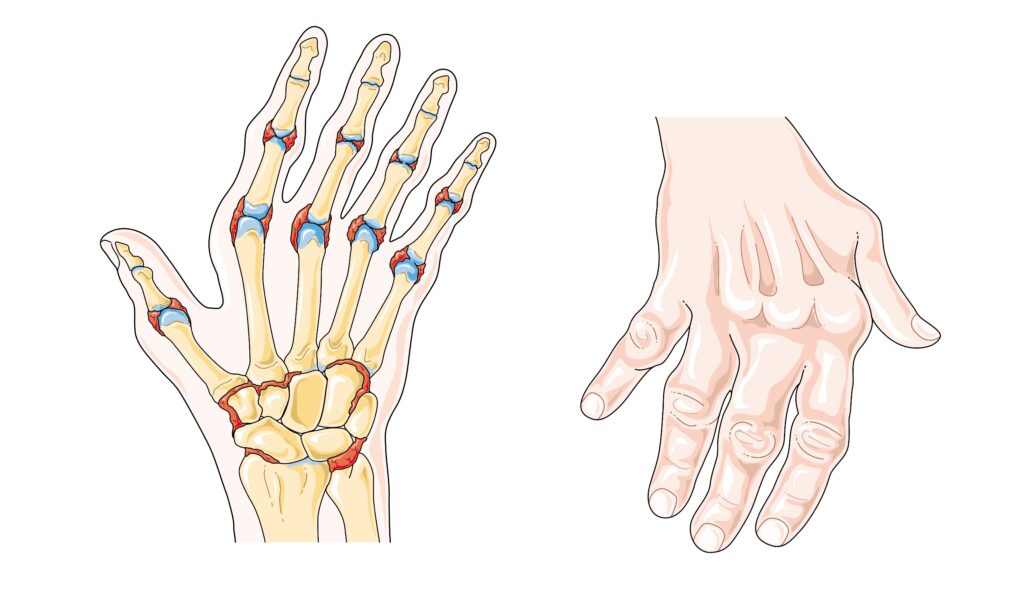 Immune system disorders